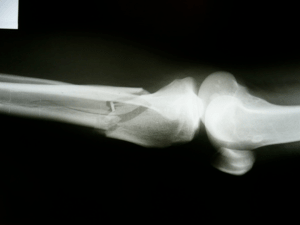picture of broken bone in the lower leg